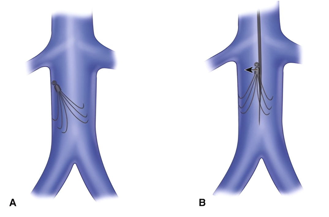 IVC Filters
